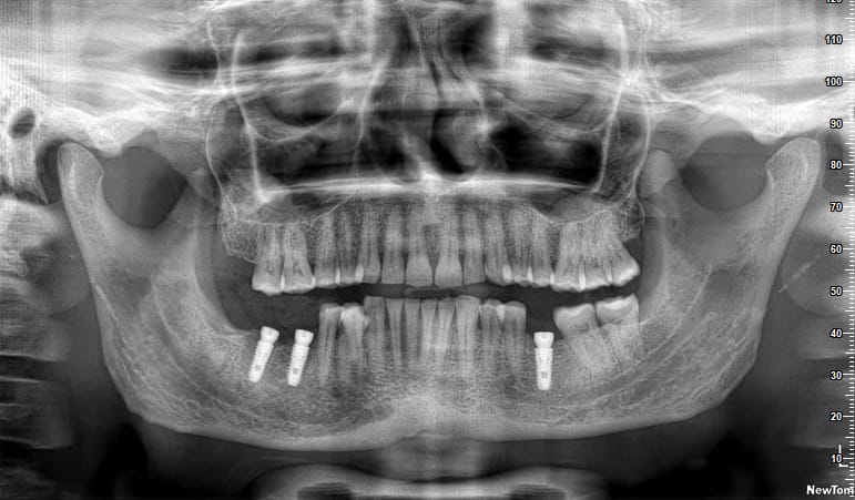 Dental Implants in lower jaw