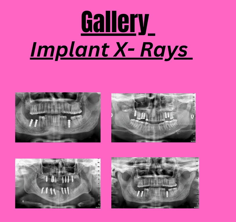 Implant X rays