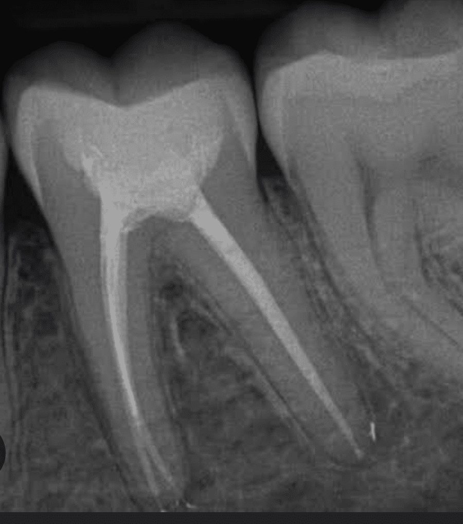 Root-canal treatment