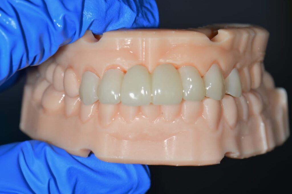 Anterior Zirconia bridge