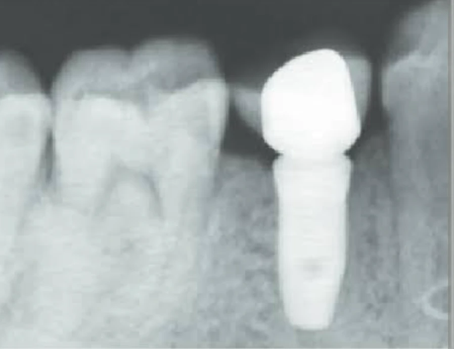 Implant IOPA