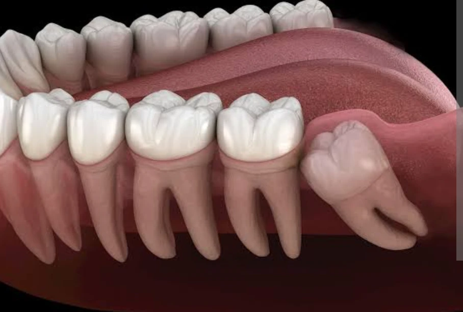 Wisdom Tooth Surgery